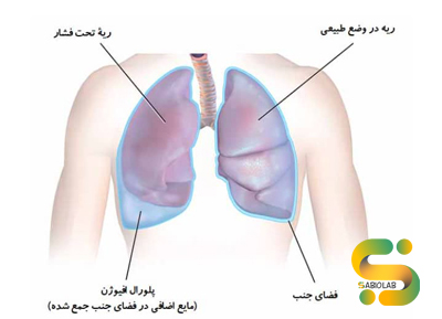 پلورال افیوژن یا آب آوردن ریه