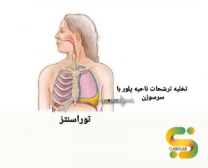 توراسنتز Thoracentesis